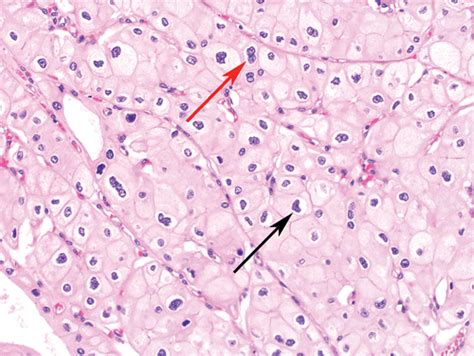 Chromophobe Renal Cell Carcinoma With Radiologic Pathologic Correlation