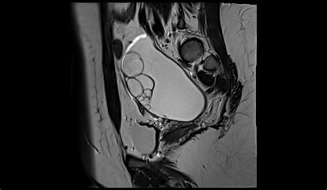 Ovarian Cancer Protocol Sagittal T2 Images Mrimaster