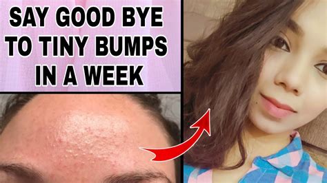 How To Get Rid Of Tiny Bumps Naturally At Home With 100 Result YouTube