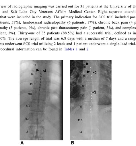 Example Of A Final Ap Fluoroscopic Image Obtained At The Time Of A