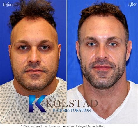 Hair Transplant San Diego Case 15 | Kolstad Hair Restoration