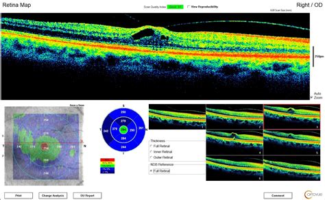 Optos Retinal Scanning | Eye Doctors in Lakewood CO