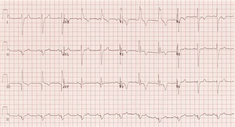 Ecg Changes In Pulmonary Embolism New Health Advisor