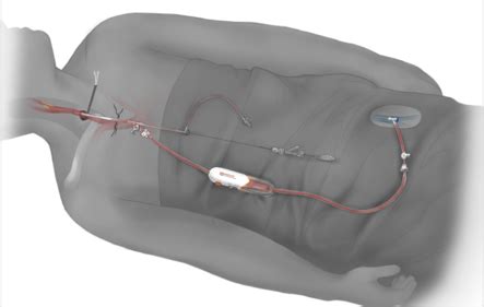 TCAR Procedure Oklahoma Heart Institute