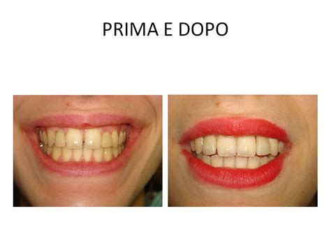 Agenesia Incisivi E Diastema Anteriore Dentista Roma