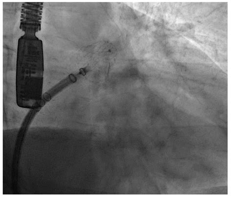 Medicina Free Full Text Percutaneous Left Atrial Appendage Closure In Patients With Non