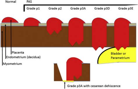 Spp And Figo Grading Systems For Placenta Accreta Spectrum Medicalkidunya