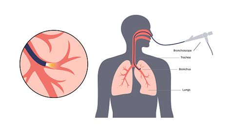 Bronchoscopy Procedure Concept Stock Illustration - Download Image Now ...