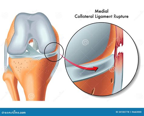 Rupture Collat Rale M Diale De Ligament Photos Libres De Droits Image