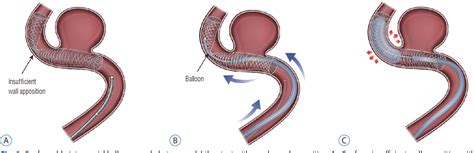 PDF The Evolution Of Flow Diverting Stents For Cerebral Aneurysms