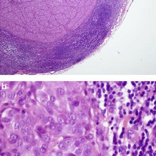 Right Axillary Lymph Node