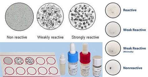 Vdrl Test Principle Procedure Result Interpretation And 41 Off