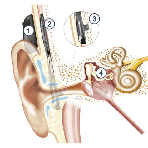 Hipoacusia Implantes Cocleares Soluciones Y Beneficios