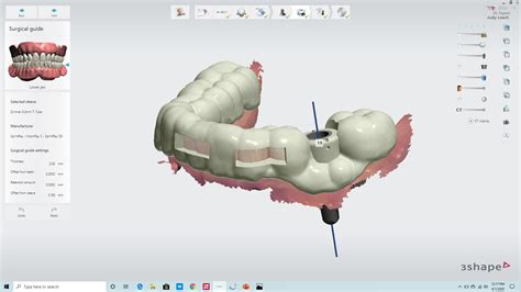 Digitally Guided Implants Riverview Dental Arts