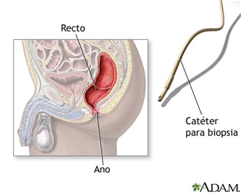 Biopsia Rectal Medlineplus Enciclopedia M Dica Illustraci N