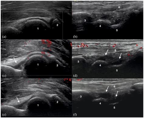 Development Of Elbow And Wrist Joint Effusion Within 48 H After The Download Scientific Diagram