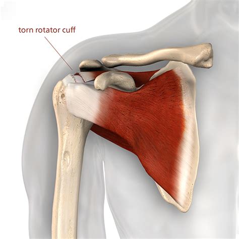 Rotator Cuff Tendonitis