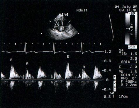四正常心脏多普勒超声心动图 临床超声心动图学 医学