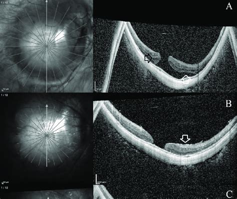 Preoperative And Postoperative Oct Images Of The Right Eye With High