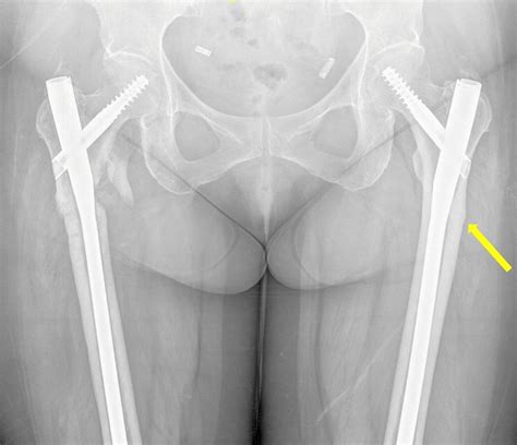 Anteroposterior Femur Radiograph Of Patient 8 With Surgical Fixation Of Download Scientific