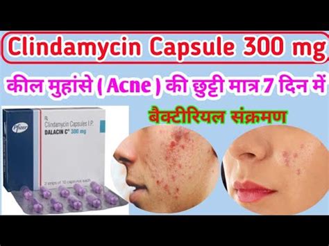 How To Use Clindamycin Capsule Clindamycin Capsule Uses In Hindi