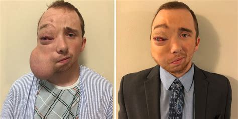 Idaho man with face tumor reveals surgery results