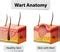 Wart Human Skin Anatomy Illustration Illustration De Vecteur