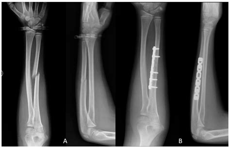 Ulna Fracture X Ray