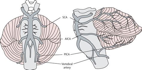 Diagnosis And Initial Management Of Cerebellar Infarction The Lancet Neurology