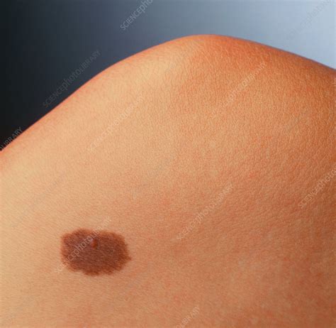 Pigmented Naevus Benign Mole On A Woman S Knee Stock Image M