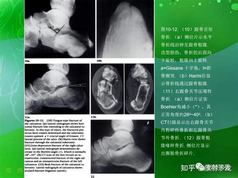 跟骨正常与变异影像表现 知乎