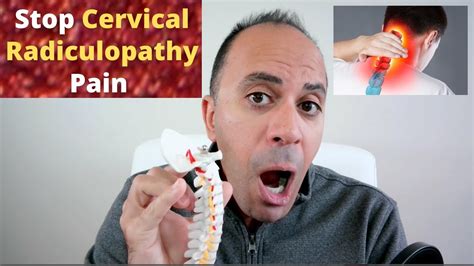 Cervical Radiculopathy Symptoms Causes Risk Factors Healing Cycle