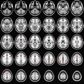 The brain regions showing increased glucose metabolism after ...