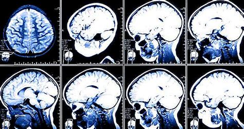 S Ntomas Del Avc Derrame Cerebral Imevictoria