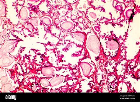 Prostate Hyperplasia Photomicrograph Showing Dilated Glands Enfolding