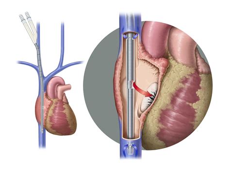 Avalon Elite Bi Caval Dual Lumen Catheter