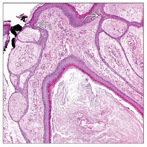 Fibrofolliculoma and Trichodiscoma | Basicmedical Key