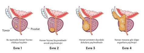 Prostat Kanseri Nedir Doç Dr Serdar Aykan