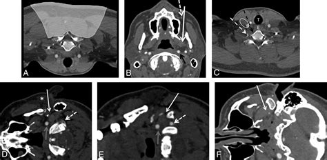 Percutaneous Ct Guided Core Needle Biopsies Of Head And Neck Masses