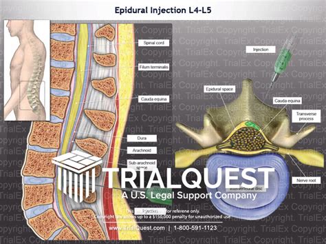 Epidural Injection L4 L5 Trialexhibits Inc