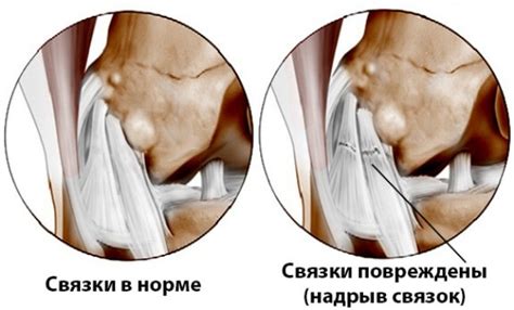 Растяжение связок тазобедренных суставов