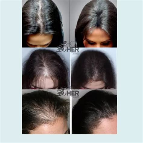 Minoxidil Crecimiento De Cabello Cejas Y Pesta As Kit En Venta En