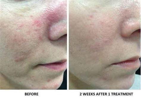 Ipl For Rosacea Bismarck Nd Pure Skin Aesthetic And Laser Center