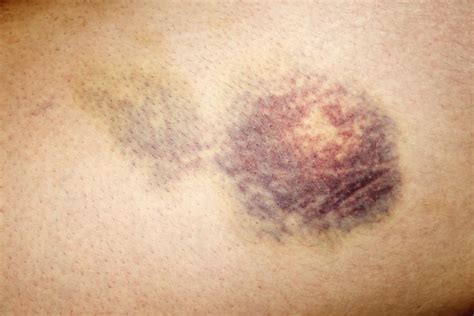 Fases De Um Hematoma Librain