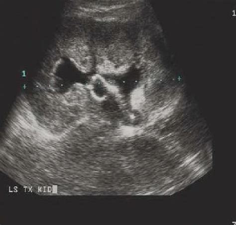 Ultrasound Of Transplant Kidney With Upper Curl Of Ureteric Stent In