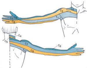 Cervical Radiculopathy - Physiopedia