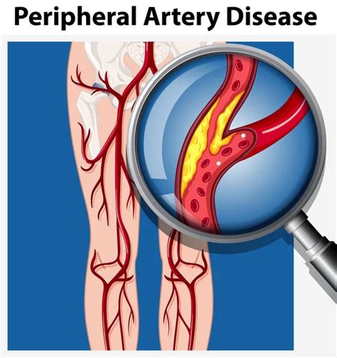 Peripheral Artery Disease Causes And Treatment Options Arynb