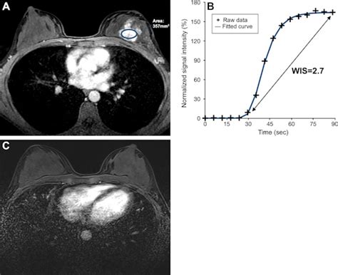 Ultrafast Dce Mri Helps Predict Breast Cancer Treatment Response