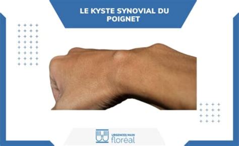 Le Kyste Synovial Du Poignet Douleurs Et Traitements