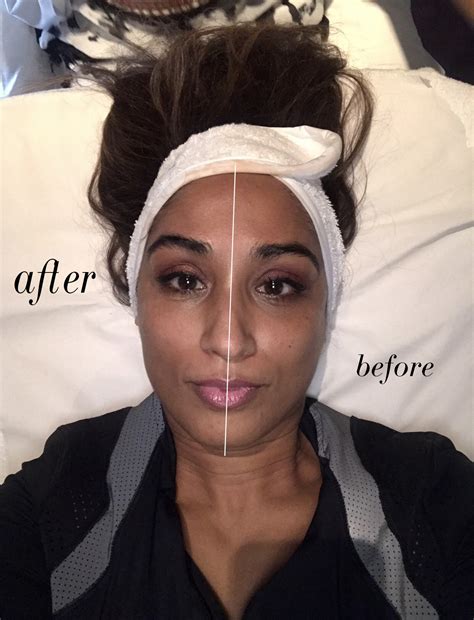 THE CREDIBLE ALTERNATIVE TO BOTOX? EVA BY ENDOSPHERES - Beauty Passionista